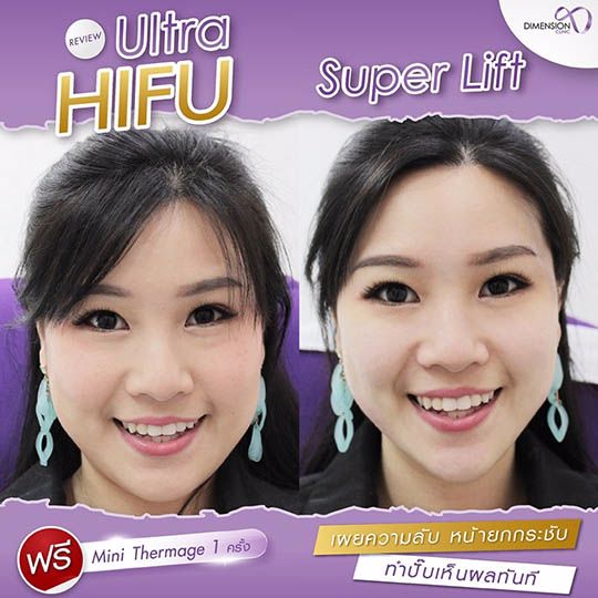 โปรปังปุริเย่! ULTRA HIFU ทั่วหน้า 5,900.- แถมฟรี Mini Thermage 1 ครั้ง